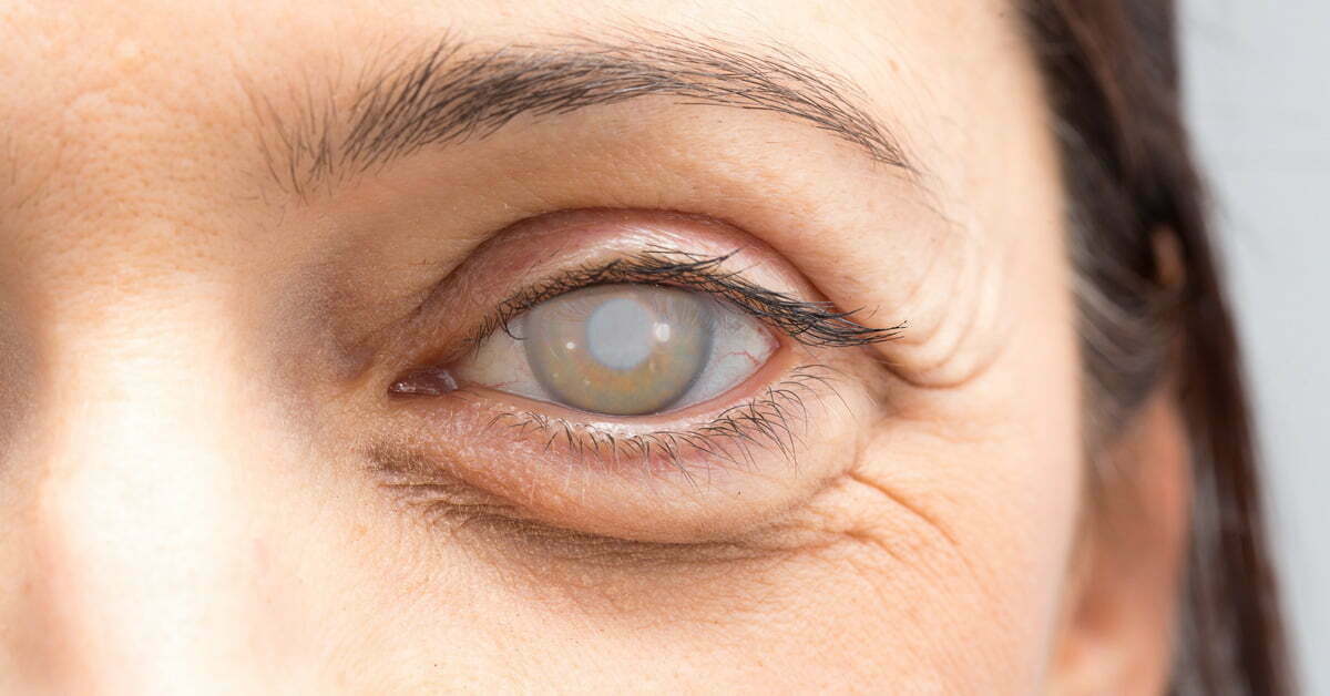 Am I Displaying Early Warning Signs of Cataracts?