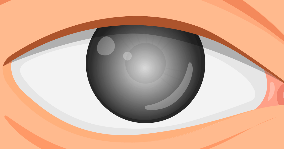 What Does Vision Look Like if You Have Glaucoma?