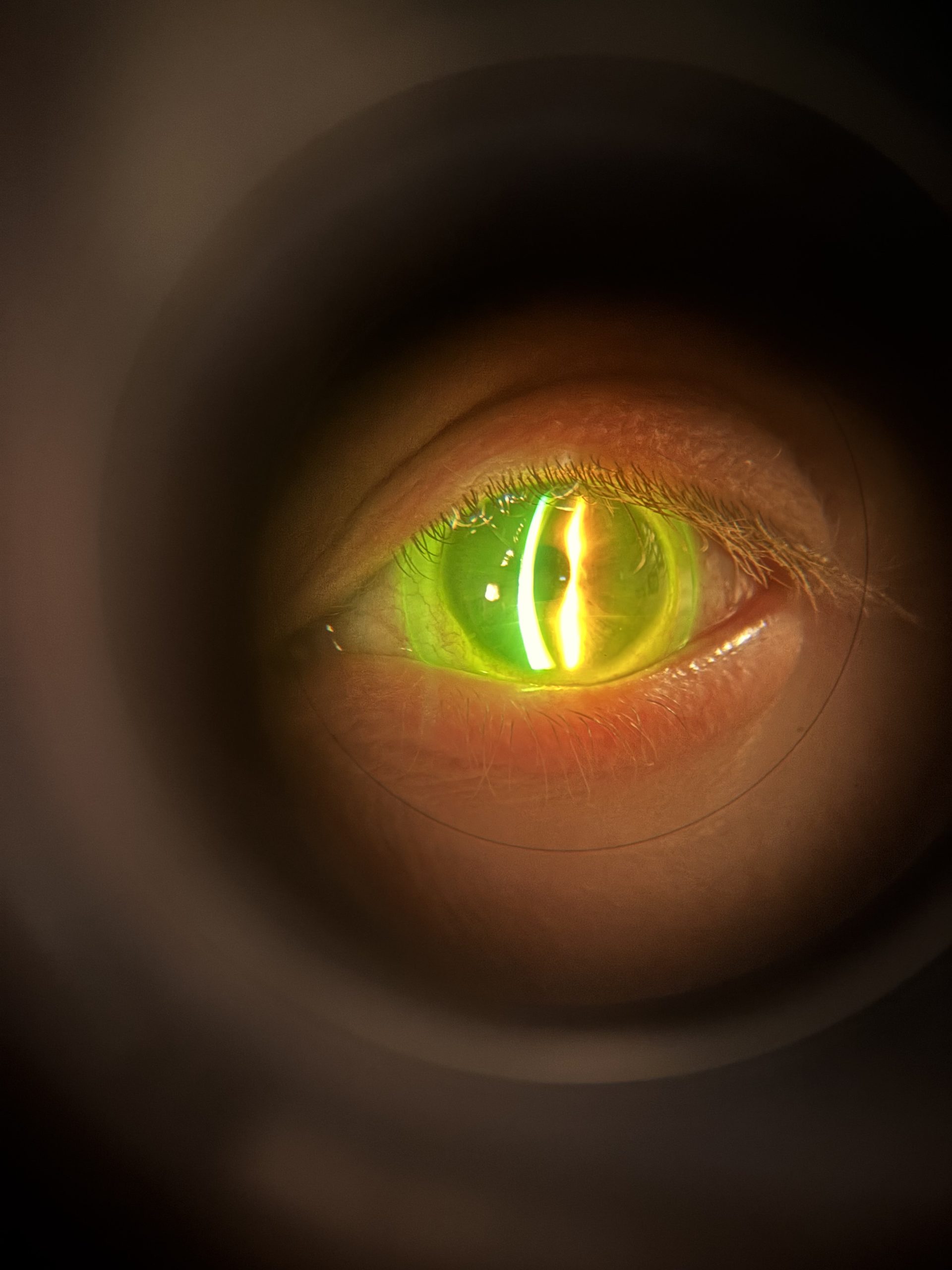 Scleral & Specialty Contact Lens Fittings